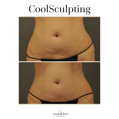COOL SCULPTING BEFORE AND AFTER (2)