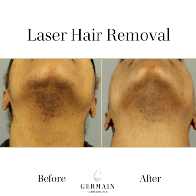 Laser Hair removal _ Germain Dermatology