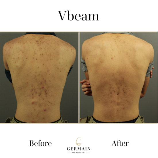 Copy of Vbeam Before and After