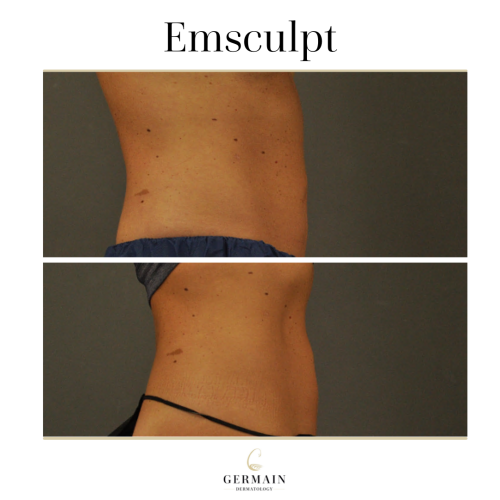 EMSCULPT BEFORE AND AFTER (2)
