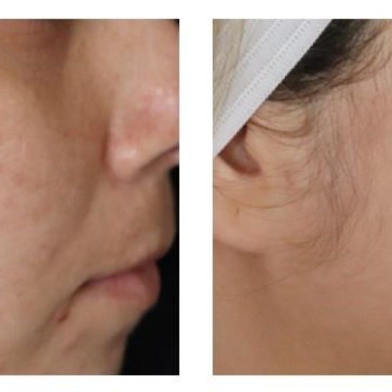 Genius RF Microneedling Before and After