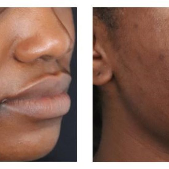 Genius RF Microneedling Before and After