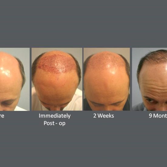 NeoGraft BEFORE AND AFTER