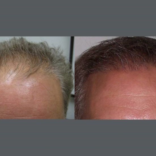 NeoGraft BEFORE AND AFTER
