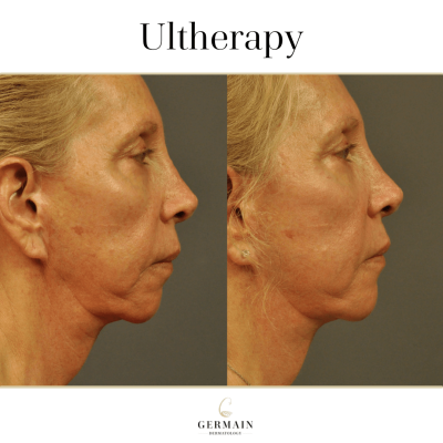 Ultherapy Before and AfterGermain Dermatology| Mt Pleasant, South Carolina