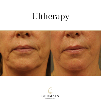 Ultherapy-Lower-Face-Before-and-After