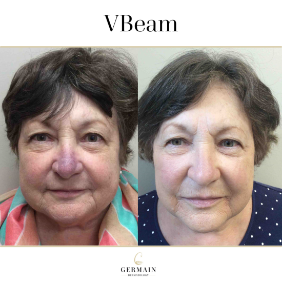 VBEAM BEFORE AND AFTER (2)