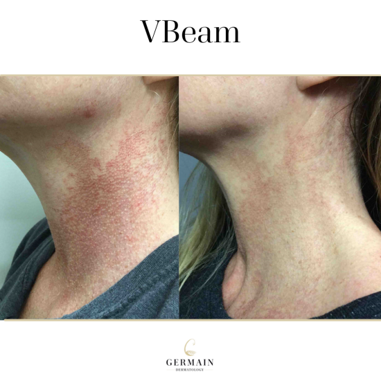 VBEAM BEFORE AND AFTER