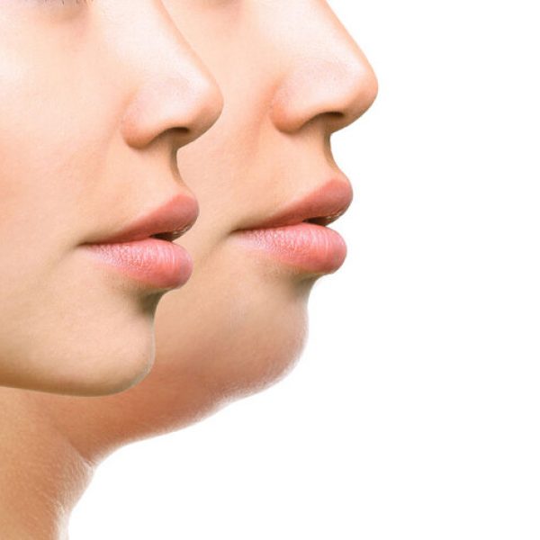 coolsculpting for chin